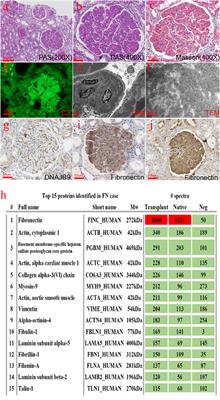 Case Report: Recurrent Deposition in Renal Allografts: A Rare Case of Fibronectin Glomerulopathy Overlooked in Native Kidneys